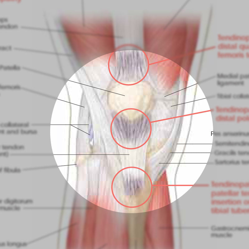 Athletic Injuries of the Knee chart - detail