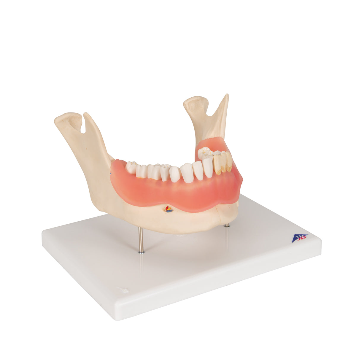 Dental Disease Model, Magnified 2 times, 21 parts - 3B Scientific D26, view 2