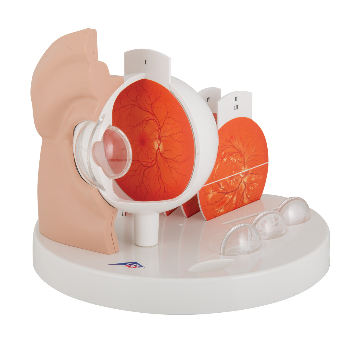 Pathological Human Eye Model