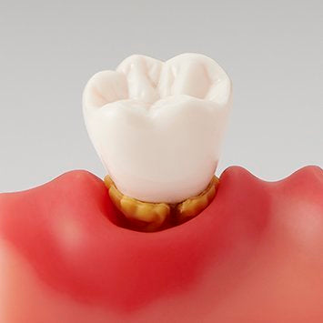 Peri-implantitis patient education model side view - PE-IMP004