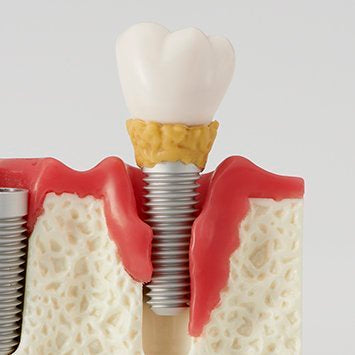 Peri-implantitis model showing mobile implant at advanced disease stage - PE-IMP004