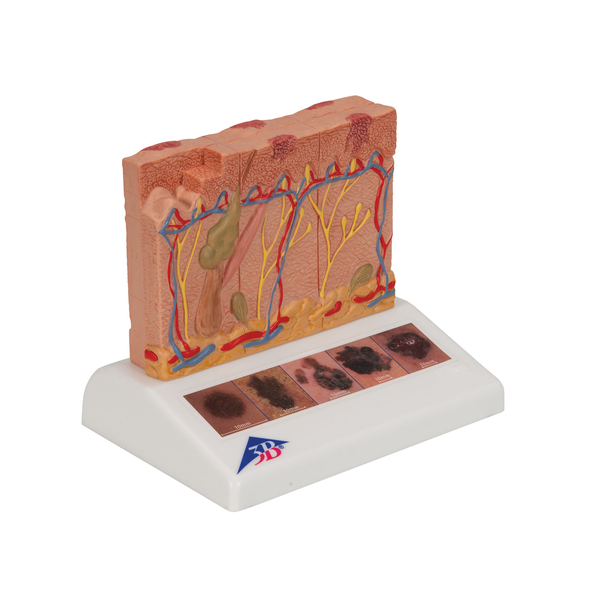 Skin Cancer Model with 5 stages, 8 times magnified