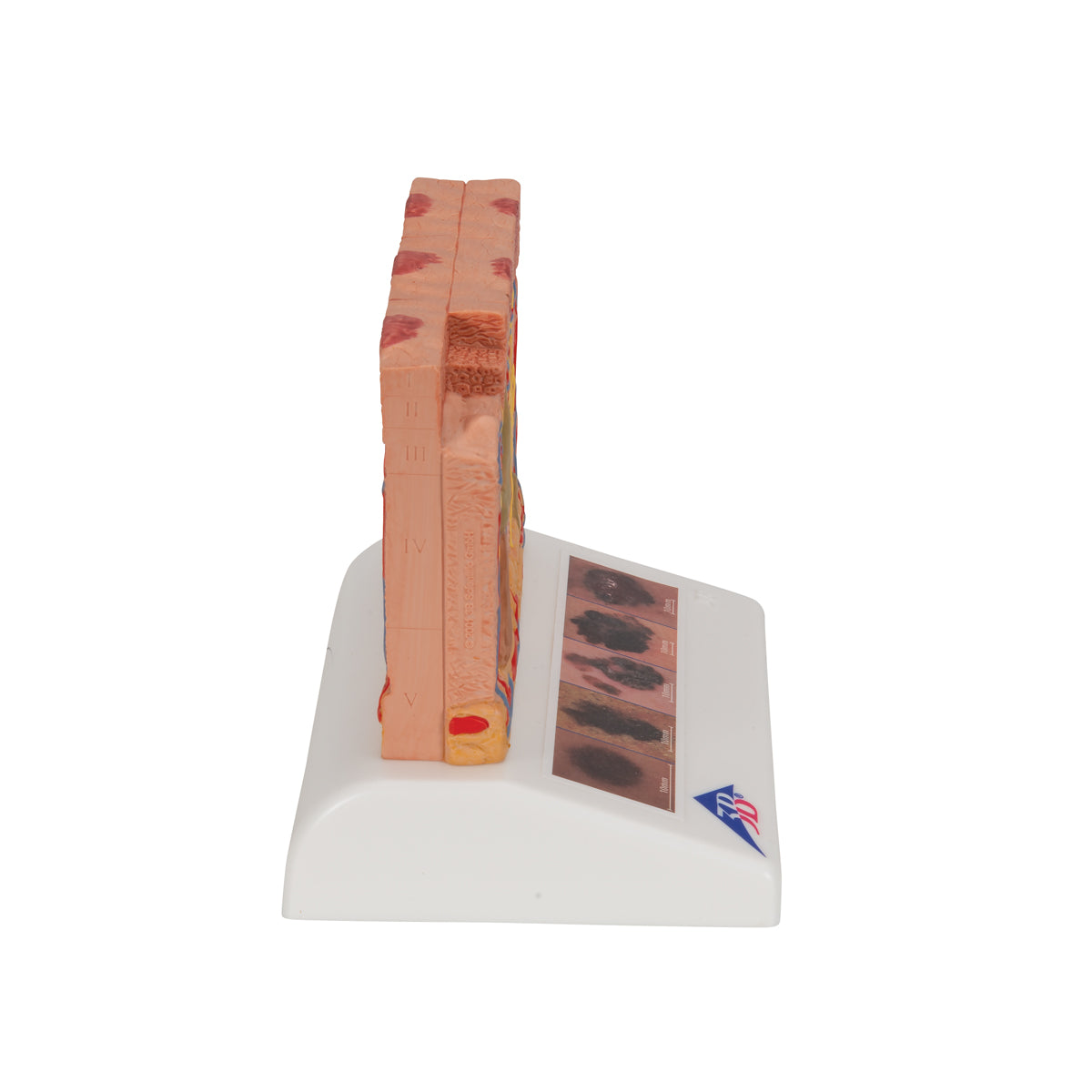 Skin Cancer Model with 5 stages, 8 times magnified