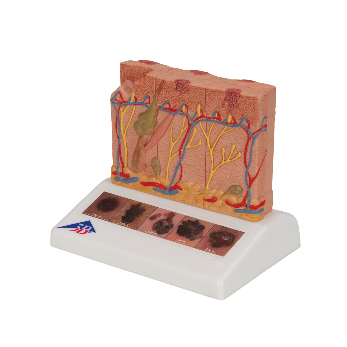 Skin Cancer Model with 5 stages, 8 times magnified
