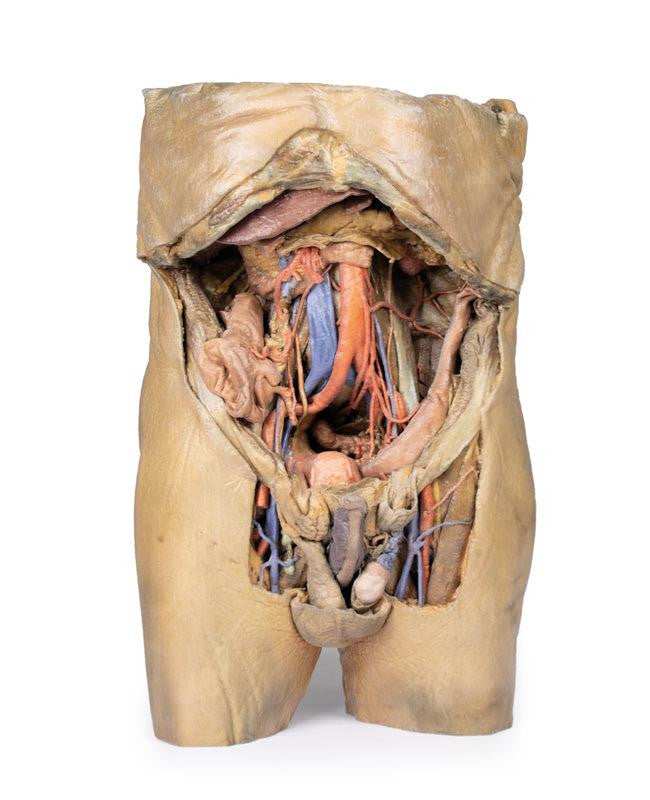 Abdomen with bilateral Hernias 3D Replica MP1130 | Erler-Zimmer | Candent