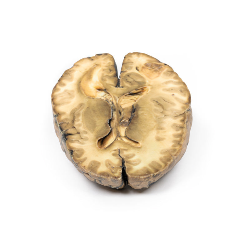 Metastatic carcinoma in the brain