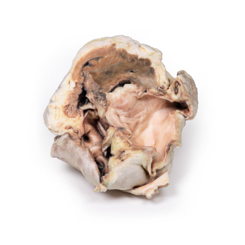 Calcified Aortic Valvular Stenosis Bicuspid Aortic Valve
