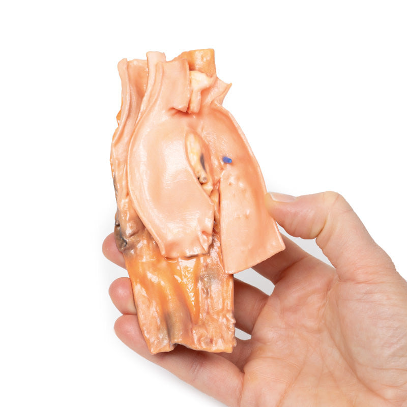 Traumatic Oesophageal-aortic fistula