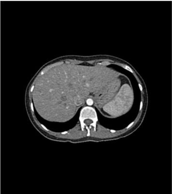 Abdomen phantom for CT, X-ray and radiation therapy