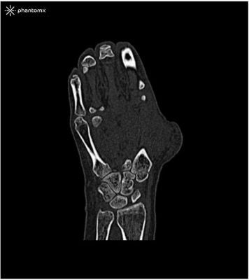 Hand phantom for CT, X-ray and radiation therapy