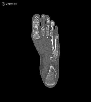 Foot phantom for CT, X-ray and radiation therapy
