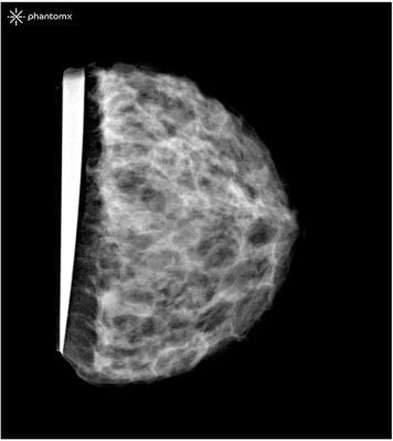 Breast Phantom for Mammography and Breast Tomosynthesis