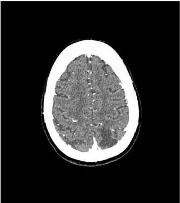Head phantom “Aneurysm” for CT, X-ray and radiation therapy