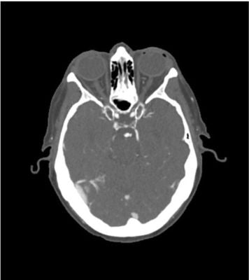 Head phantom “Aneurysm” for CT, X-ray and radiation therapy