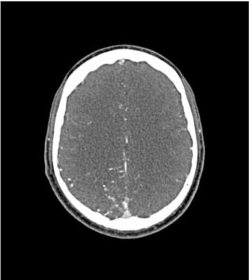Head phantom “AVM” for CT, X-ray and radiation therapy