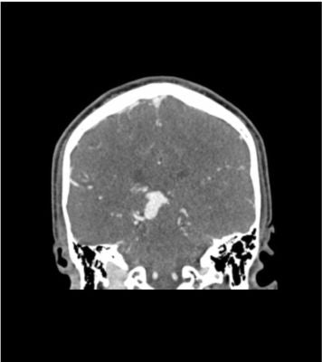 Head phantom “AVM” for CT, X-ray and radiation therapy