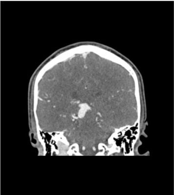 Head Phantom “AMV and Lesion” for CT, X-ray and radiation therapy