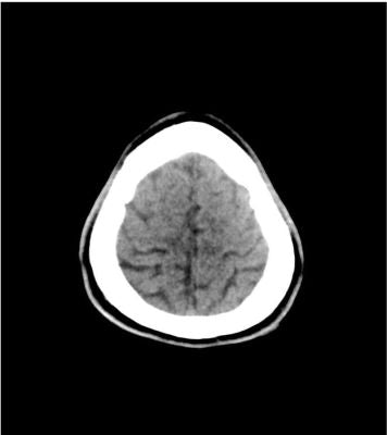 Head Phantom Stroke / Bleed