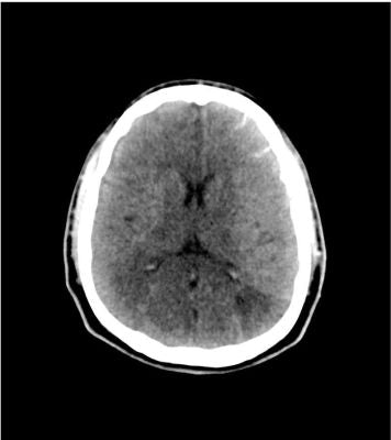 Head Phantom Stroke / Bleed