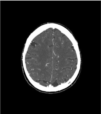 Head and Neck Phantom for CT, X-ray and radiation therapy