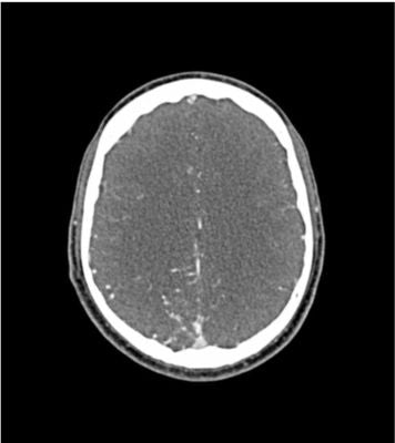 Head / neck CTA phantom AVM