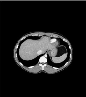 Abdomen phantom portalvenous phase