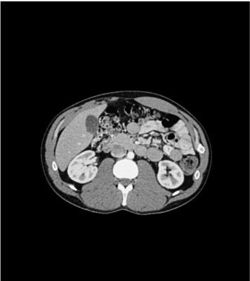 Abdomen phantom portalvenous phase