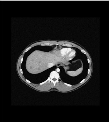 Abdomen phantom low contrast spheres