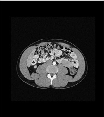 Abdomen phantom low contrast spheres