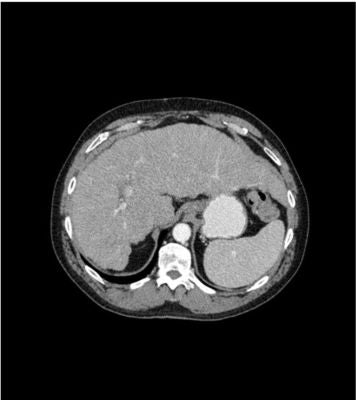 Abdomen phantom pv cirrhosis