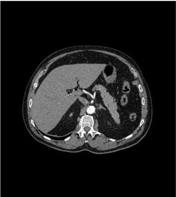 Abdomen phantom aortic aneurysm