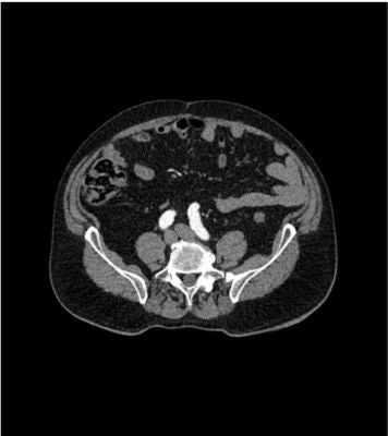 Abdomen phantom aortic aneurysm
