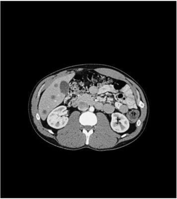 Abdomen phantom pv mixed cylinders