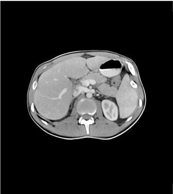 Abdomen/Pelvis Phantom Portal venous phase