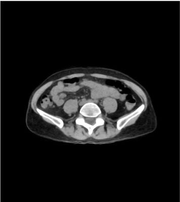Abdomen / pelvis phantom native