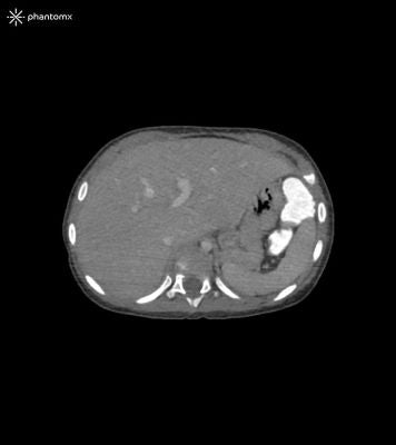 Child Torso Phantom 1-year-old