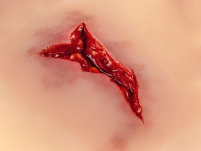 Wound moulage "laceration"