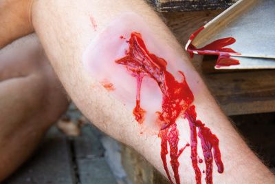 Wound moulage "laceration"