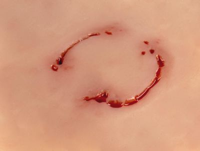 Wound moulage "human bite"