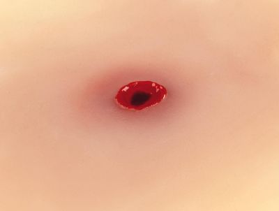 Wound moulage bullet entrance hole
