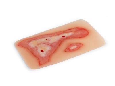 Wound moulage scalding
