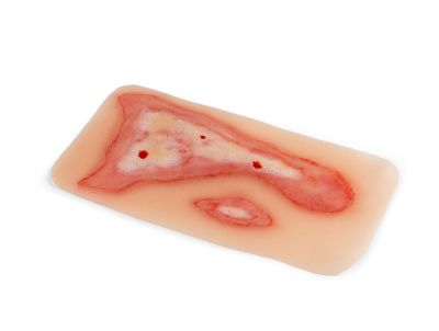Wound moulage scalding