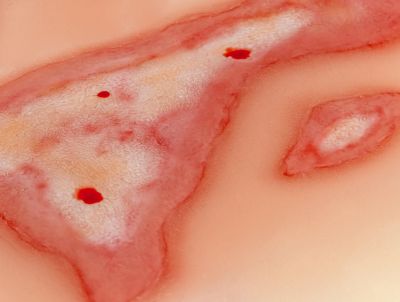 Wound moulage scalding