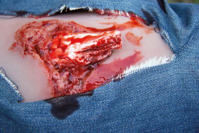 Wound moulage open fracture, leg with bleeding function