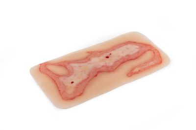 Wound moulage scalding