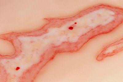 Wound moulage scalding