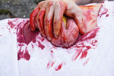 Wound moulage protrusion of large intestines
