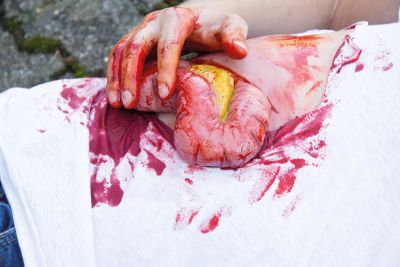 Wound moulage protrusion of large intestines