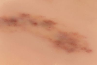 Wound moulage hematoma fresh