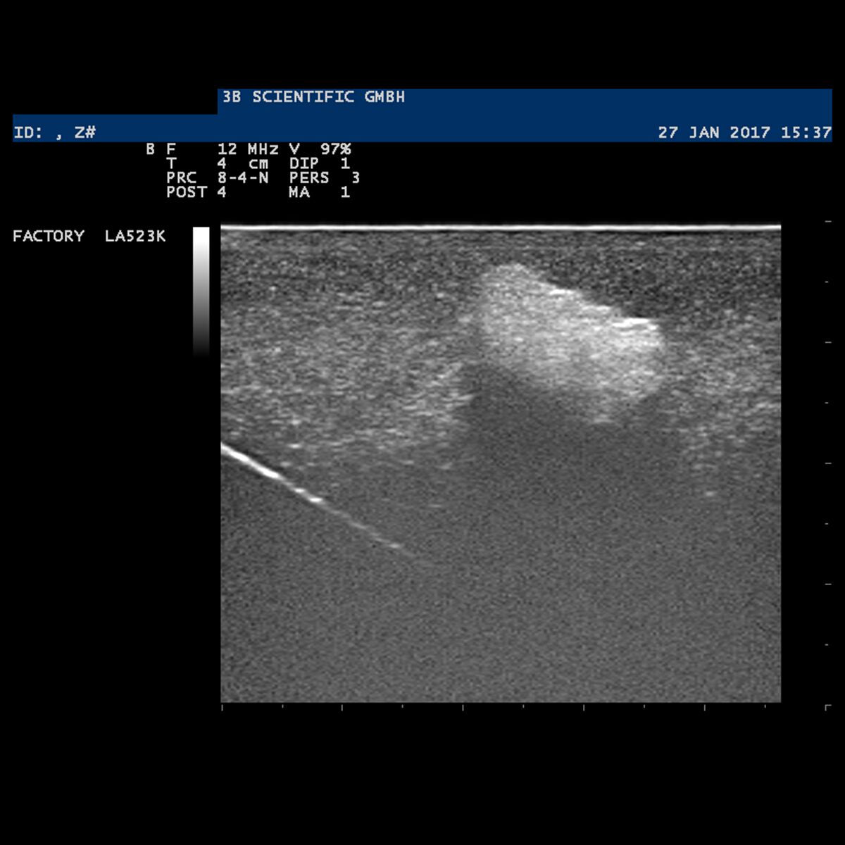 SONOtrain Breast Model with Cysts dark skin